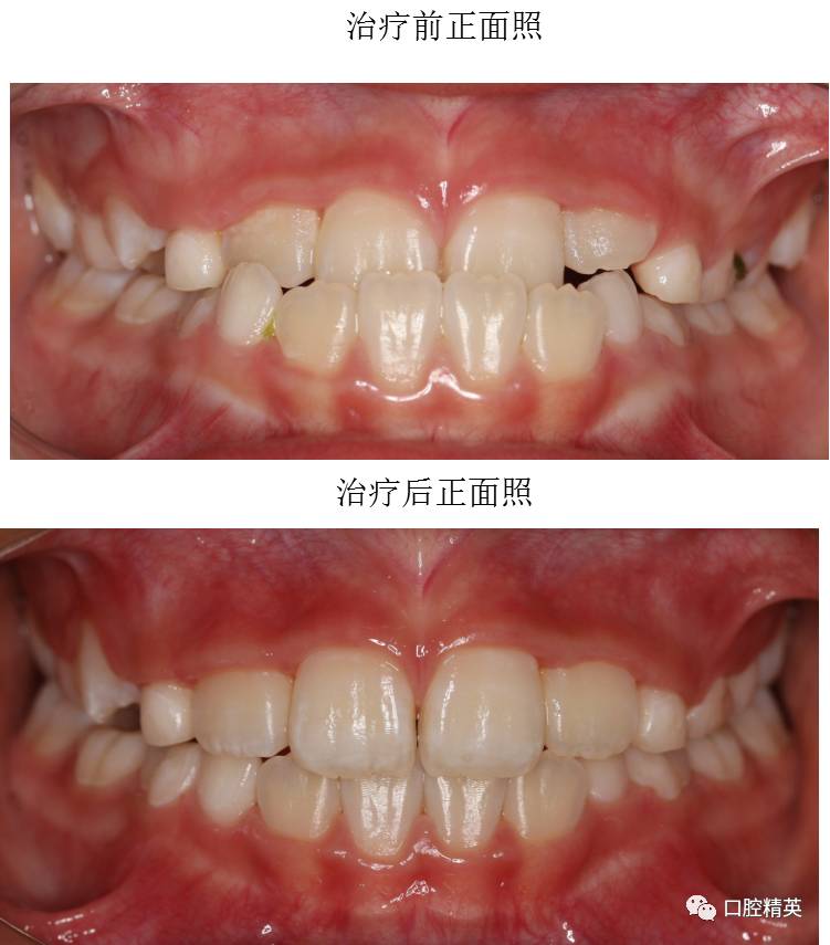 关于mrc解除替牙期反颌的经典病例