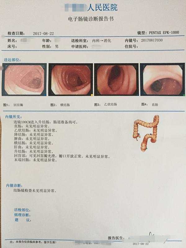 肠镜检查痛苦吗?药师亲历结肠镜检查,普通肠镜怎么做