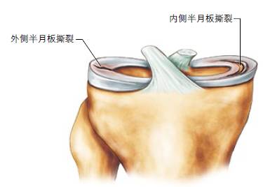 健身｜全方位解析，美国专业医生告诉你：运动损伤如何自我治疗