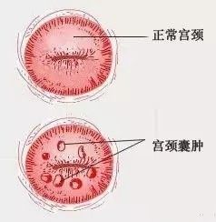 分享平衡医学轻松消除宫颈囊肿