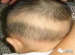 由于缺钙宝宝易出汗,经常通过转头散热,导致后脑勺处的头发被磨光引发