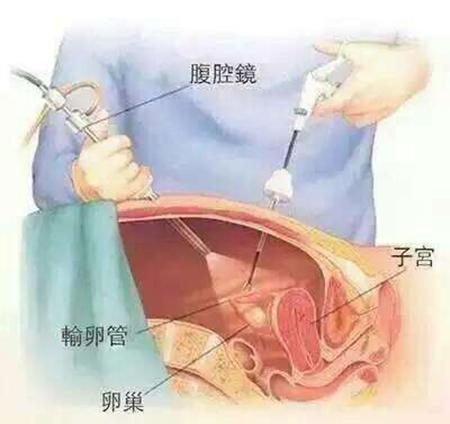 因盆腔粘连而惆怅,术后促排却意外收获双胞胎