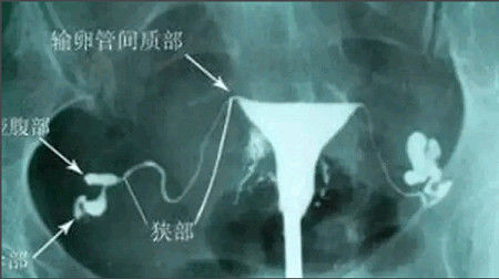 怀疑输卵管堵塞了,你该做哪些检查?