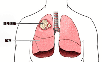 外科手术为什么能治疗肺癌,什么样的病人才适合外科