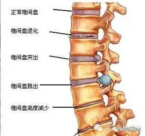 腰椎间盘突出,膨出,脱出的区别