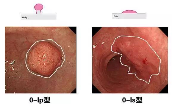 手把手教你利用胃镜发现早期胃癌