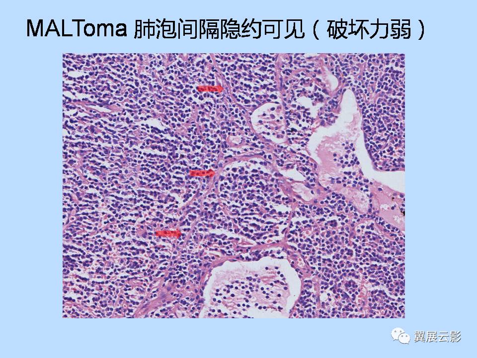 经典回顾肺癌的病理影像学