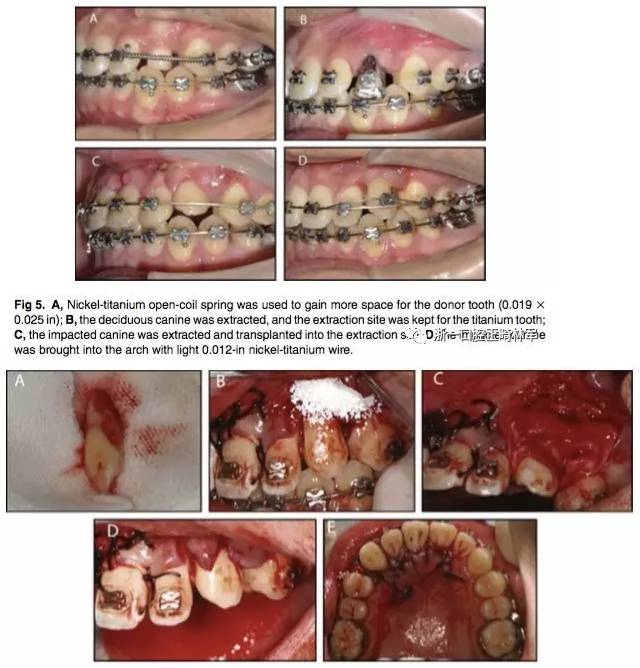 【鼎元分享】文献优秀正畸病例赏析--尖牙自体牙移植术:拔牙后使用钛