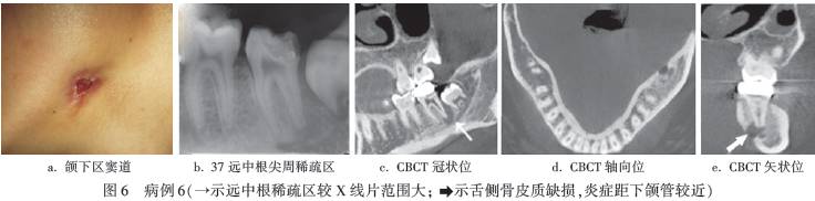 病例分享cbct辅助诊断牙源性窦道六例