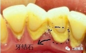 牙石掉了一块怎么办