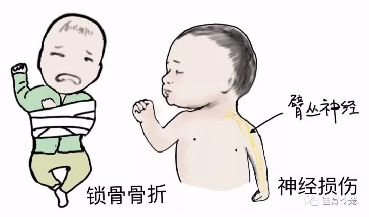 宝宝出生时可能会出现产伤:锁骨骨折,臂丛神经损伤等.