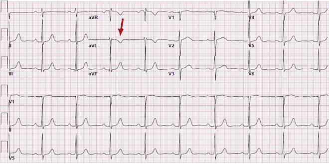 正常心电图,avl导联st段无压低