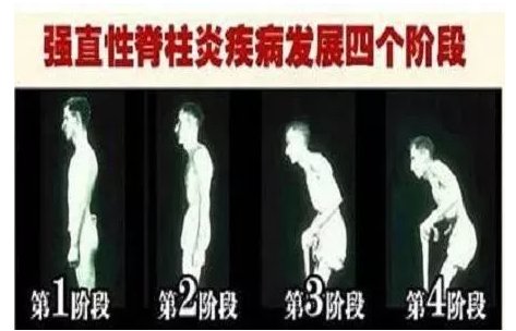 北京国康医院摆脱强直性脊柱炎先注意这3个问题