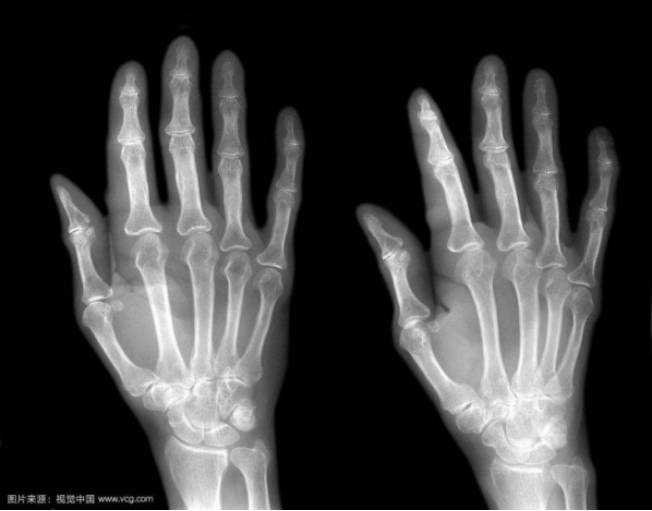 1,图为左手正斜位x光片x光片,ct,核磁共振在临床上是医学影像检查的几