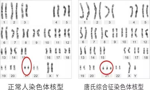 唐氏综合征是最常见的一种染色体异常,又称为21三体,在人群活产中的