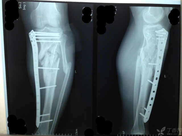 2014 年   月,小腿中段前方形成了窦道流脓,拆除了钢板.
