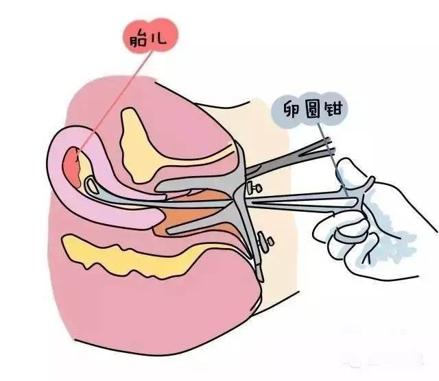 『必读』一组漫画告诉你:药流和人流的全过程!