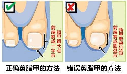 大脚趾头指甲往肉里长怎么办