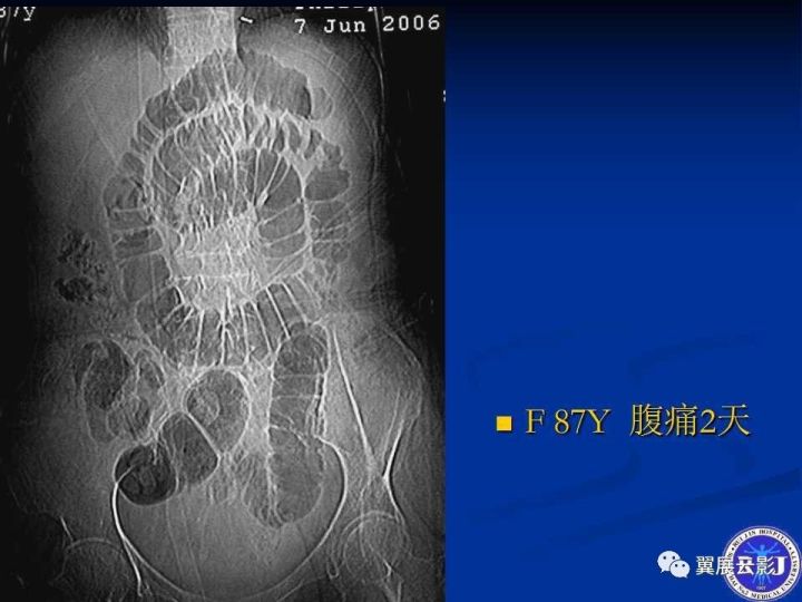 急性绞窄性肠梗阻ct诊断