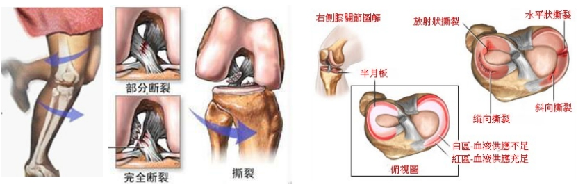 膝关节半月软骨损伤的诊断与治疗手法