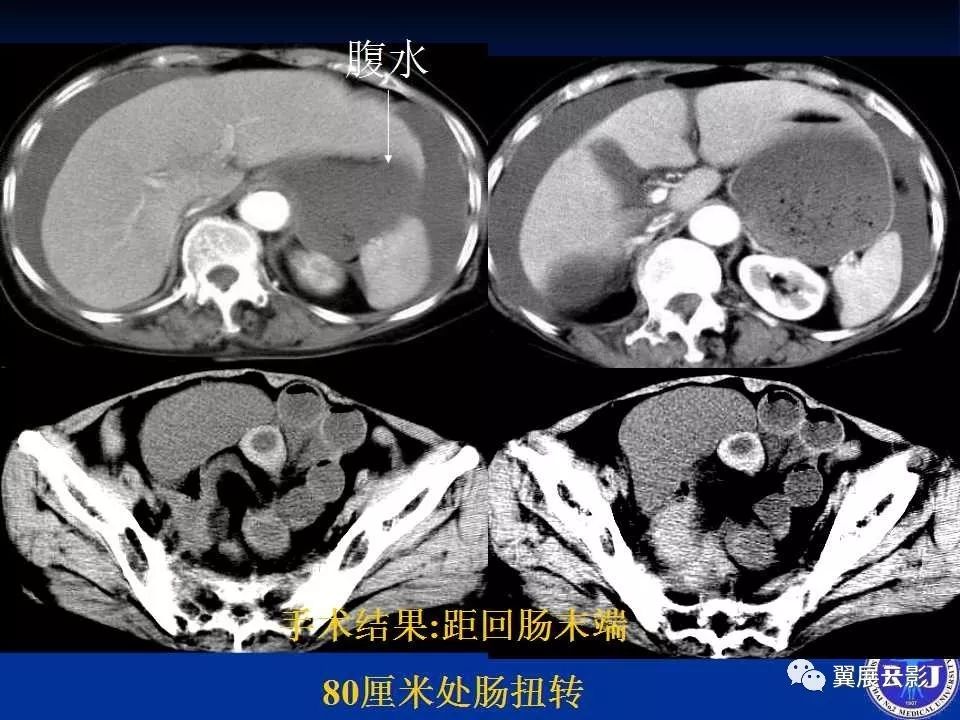 急性绞窄性肠梗阻ct诊断