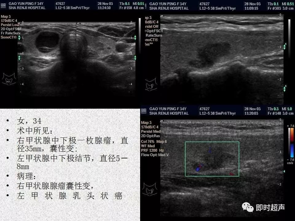 甲状腺超声诊断