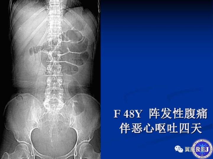 急性绞窄性肠梗阻ct诊断