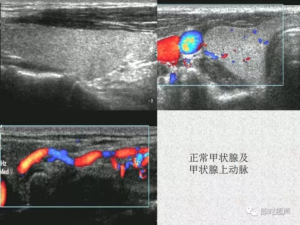 甲状腺超声诊断