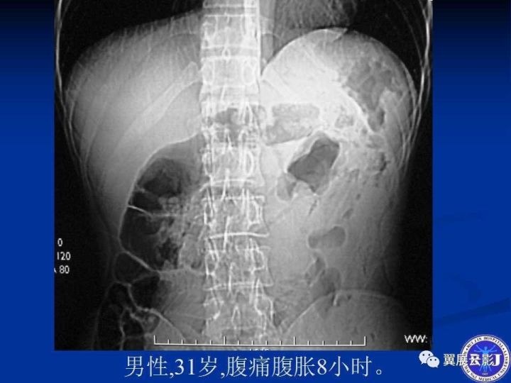 急性绞窄性肠梗阻ct诊断