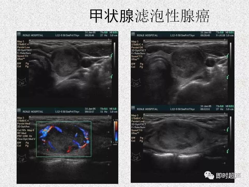 甲状腺超声诊断