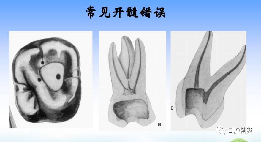 详解:各牙位的开髓【整理版】