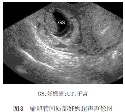 观察妊娠囊与宫角之间的线性高回声,即"间质线样征"来判断间质部妊娠