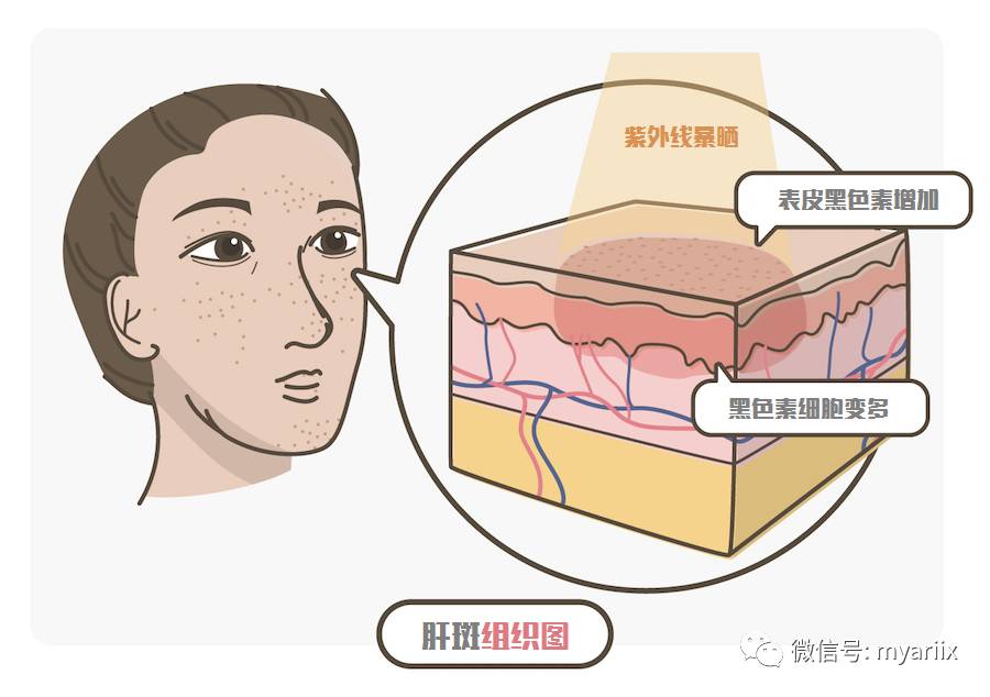 肝斑怎么来的?肝斑的保养,预防全攻略 - 最新整理版