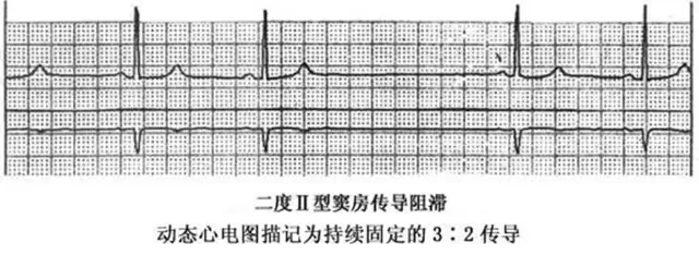 二度Ⅱ型房室传导阻滞:pr间期正常,恒定不变,p波后有qrs波脱落.