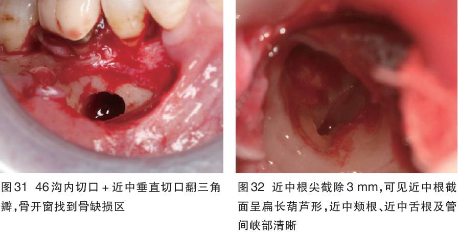 显微根尖手术——牙体牙髓保留患牙的最后一步