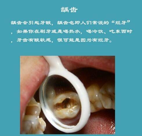 2,牙本质敏感症