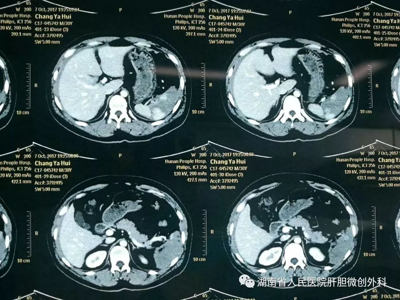 腹部（肝/脾/肾）外伤丨损伤分级、CT表现_血肿_areas_病例