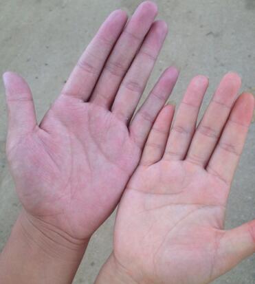 健康 正文  ①正常人的手掌颜色应该是淡粉色的,如果颜色变艳红,则有