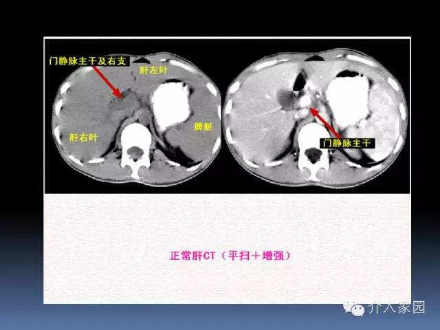 典藏肝脏分段及血管详细辨识