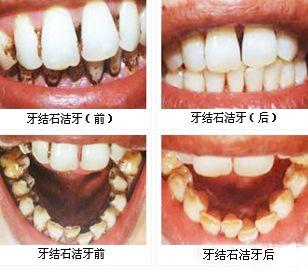 知道你的牙齿有多脏吗?牙缝都积满了细菌,洗牙的9大谣言需知道