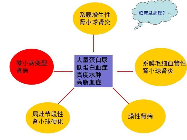 【教学查房】肾病综合征