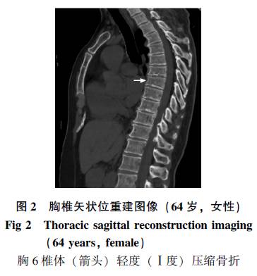 胸,腰椎骨折的x线与ct检查对照分析