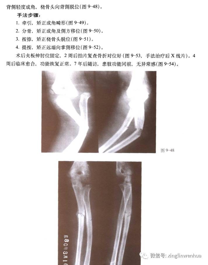 前臂尺骨上1/3骨折合并上尺桡关节脱位