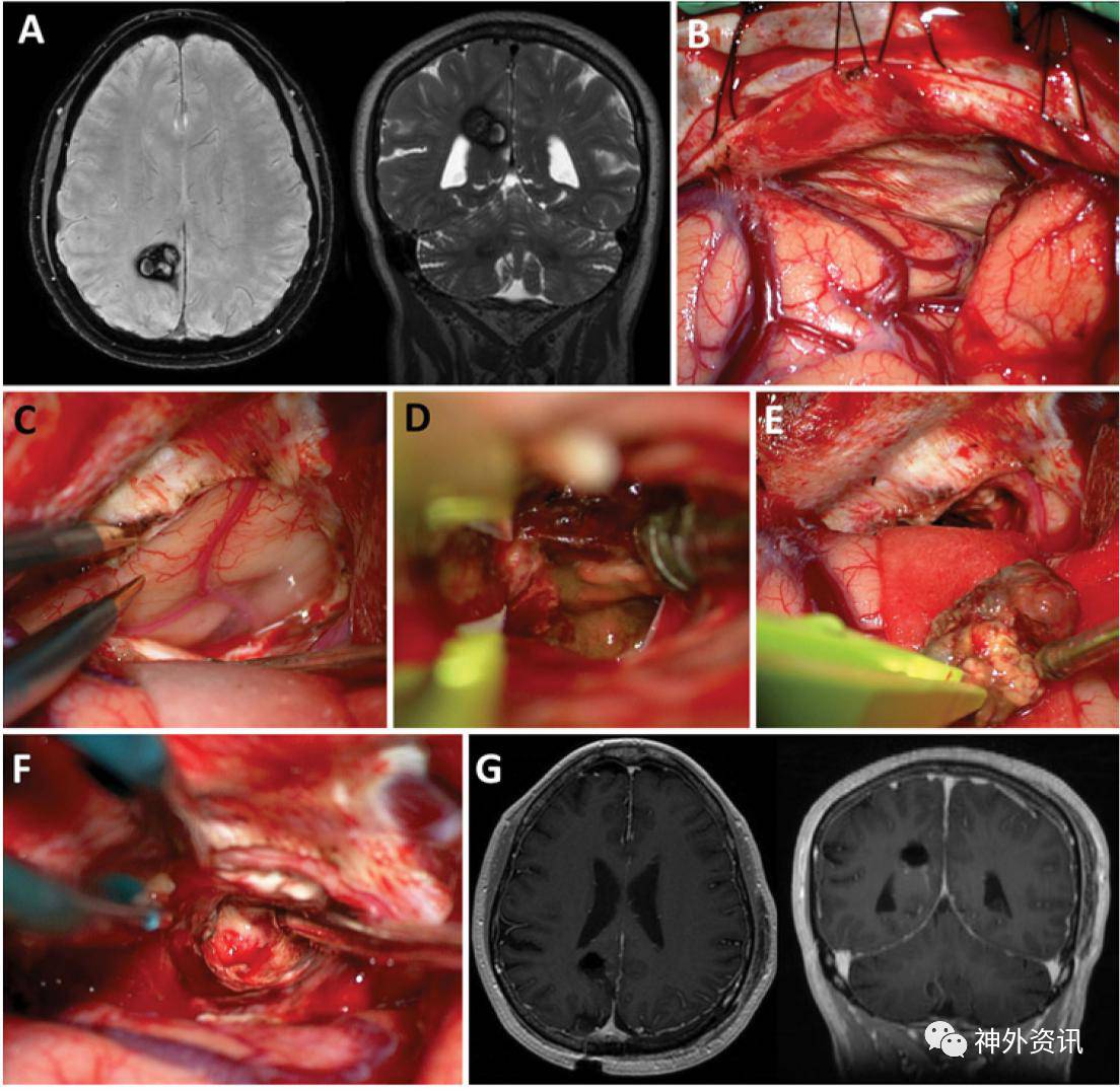 经对侧后纵裂入路切除顶枕叶内侧面深部血管畸形