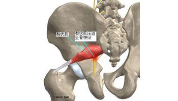 臀上筋出槽的诊断与治疗手法