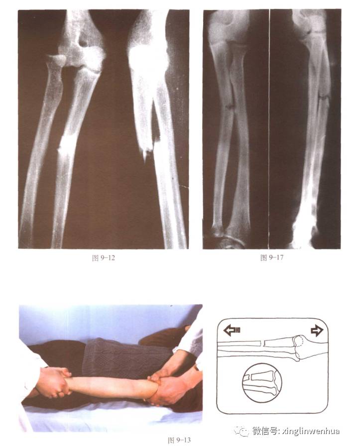 前臂尺骨上13骨折合并上尺桡关节脱位