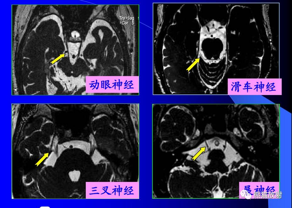 颅神经 mri 断层解剖【收藏】