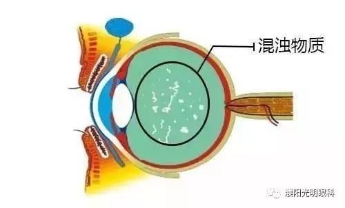 眼科专家建议：面对玻璃体混浊与眼内闪光，及时就医确保视力健康