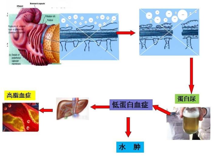 【教学查房】肾病综合征