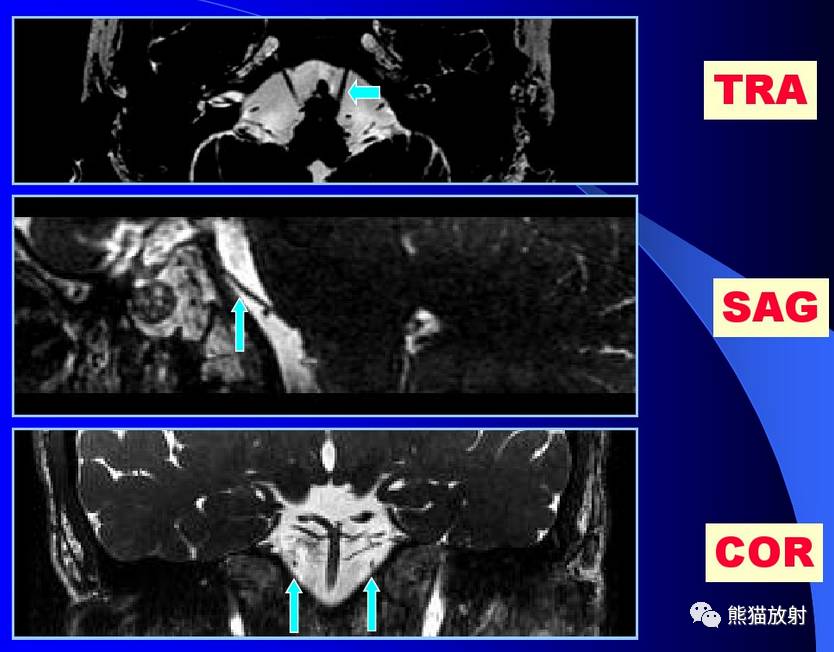 颅神经 mri 断层解剖【收藏】